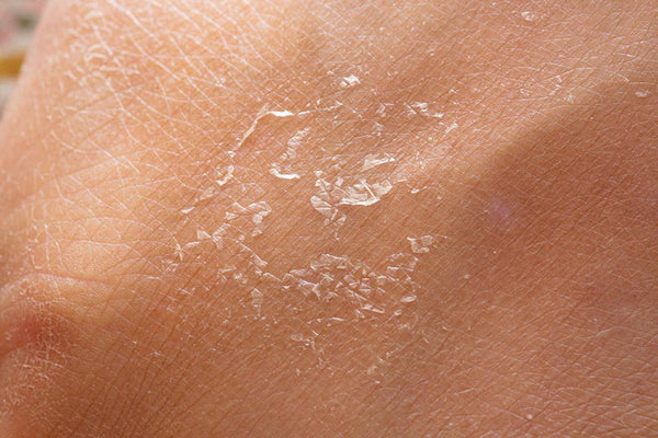 Dryness