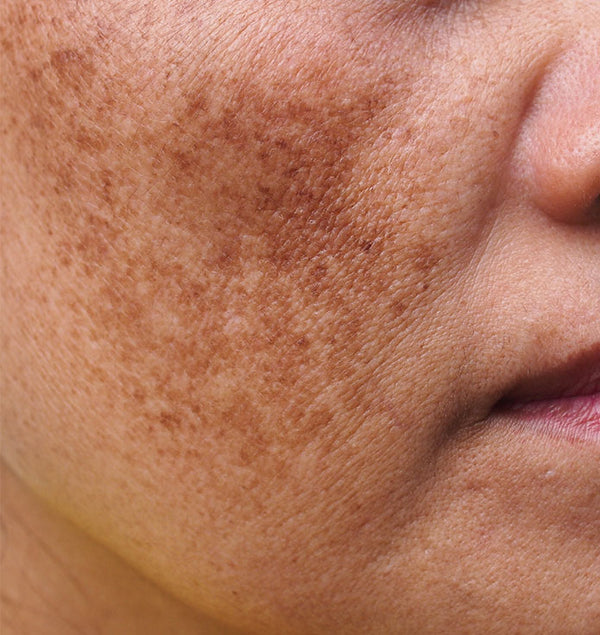 Pigmentation